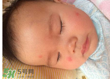 嬰兒蚊子咬了怎么消腫？嬰兒蚊子咬了怎么消腫止癢最快？