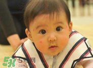 嬰兒蚊子咬了怎么消腫？嬰兒蚊子咬了怎么消腫止癢最快？