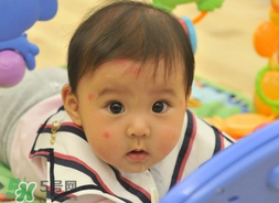 嬰兒被蚊子咬了如何去紅點？被蚊子咬后紅點如何去除？