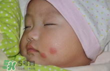嬰兒被蚊子咬了如何去紅點？被蚊子咬后紅點如何去除？
