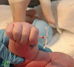 新生兒手握避孕環(huán)出生是怎么回事？出生后健康嗎？