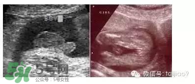 B超單數(shù)據(jù)怎么看男女？B超單看男女準(zhǔn)嗎？