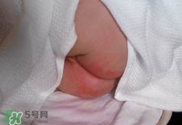 尿布疹怎么辦？寶寶尿布疹擦什么藥好？