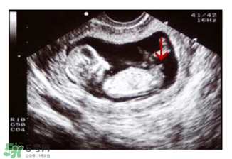 NT超圖全景看寶寶性別，親證有效的B超自測(cè)男女方法