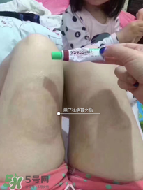 日本msd祛疤膏怎么樣？日本msd祛疤膏有用嗎？
