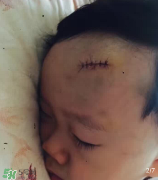 日本msd祛疤膏是抗生素嗎？日本msd祛疤膏是不是抗生素？