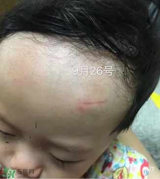 日本msd祛疤膏是抗生素嗎？日本msd祛疤膏是不是抗生素？