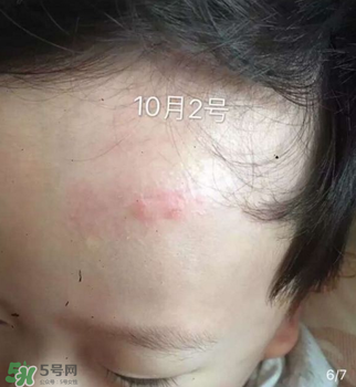 日本msd祛疤膏是抗生素嗎？日本msd祛疤膏是不是抗生素？