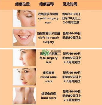 kelo cote疤痕凝膠效果好嗎？芭克硅膠軟膏效果怎樣