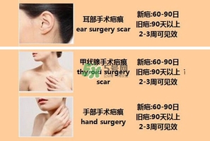 kelo cote疤痕凝膠效果好嗎？芭克硅膠軟膏效果怎樣