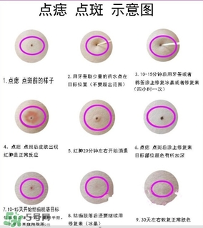 藥水點(diǎn)痣和激光點(diǎn)痣哪個好？各有什么優(yōu)缺點(diǎn)