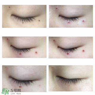 藥水點(diǎn)痣和激光點(diǎn)痣哪個好？各有什么優(yōu)缺點(diǎn)