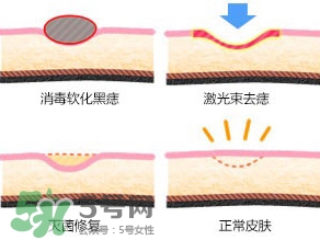 藥水點(diǎn)痣和激光點(diǎn)痣哪個好？各有什么優(yōu)缺點(diǎn)