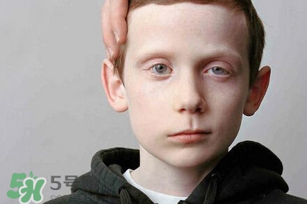 面癱是什么導(dǎo)致的？面癱多久徹底恢復(fù)正常