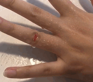 液體創(chuàng)可貼防水嗎？液體創(chuàng)可貼防水嗎透氣嗎？