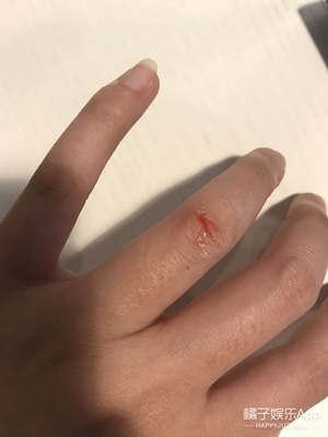 液體創(chuàng)可貼防水嗎？液體創(chuàng)可貼防水嗎透氣嗎？