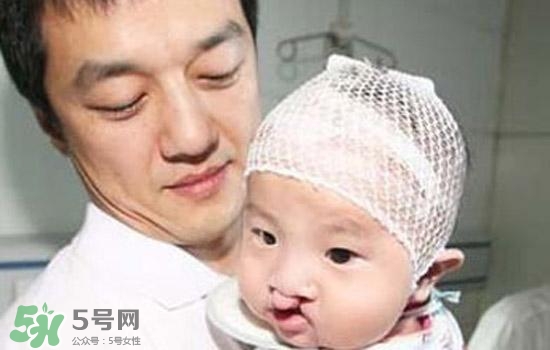 兔唇是什么？兔唇是什么原因造成的？