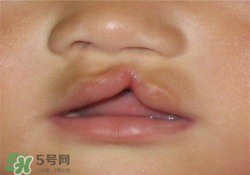 兔唇能檢查出來嗎？兔唇能完全修復(fù)嗎？