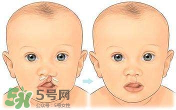 兔唇能檢查出來嗎？兔唇能完全修復(fù)嗎？