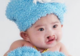 兔唇可以治嗎？兔唇修補術(shù)
