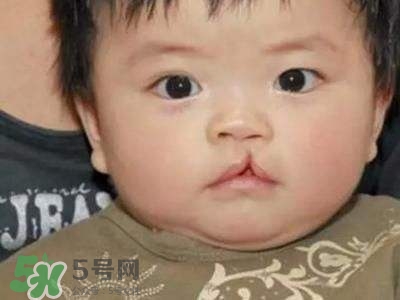 兔唇可以治嗎？兔唇修補(bǔ)術(shù)