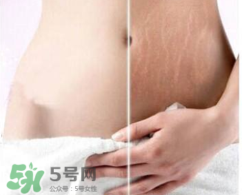 妊娠紋怎么長在大腿上了？妊娠紋會不會長在大腿上？
