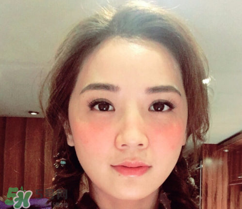 夏天可以點痣嗎？夏天點痣后要注意什么？