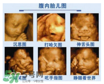 四維彩超有必要做嗎？四維彩超檢查不出什么？