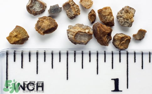 腎結(jié)石有什么癥狀？腎結(jié)石原因