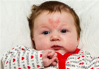 寶寶胎記是怎么來(lái)的？寶寶胎記是怎么形成的？