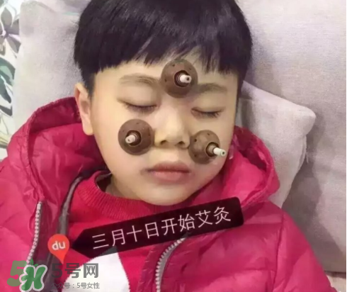 艾灸貼可以治咳嗽嗎？艾灸貼可以治退燒嗎？