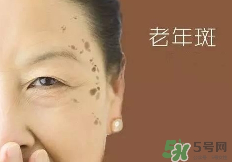 老年斑多大年齡開始有？為什么牙膏能去老年斑？