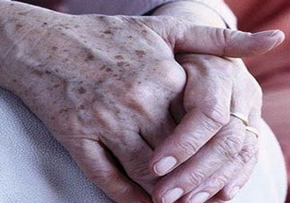 老年斑多大年齡開(kāi)始有？為什么牙膏能去老年斑？