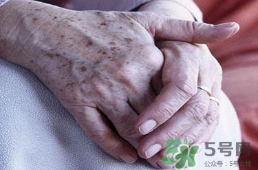 老年斑多大年齡開始有？為什么牙膏能去老年斑？