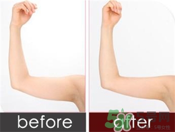 水動力吸脂的優(yōu)點(diǎn) 水動力吸脂的缺點(diǎn)