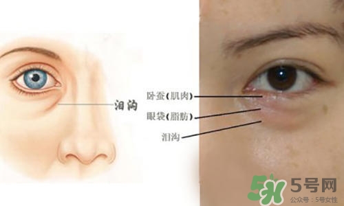 淚溝能自己恢復(fù)嗎？淚溝怎么自己恢復(fù)？