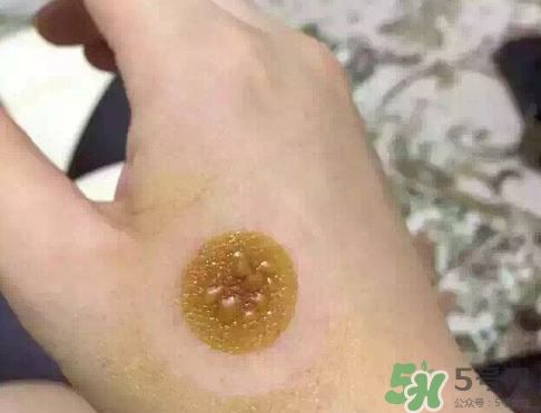 艾灸貼后有水泡怎么辦？貼艾灸貼應(yīng)注意些什么？