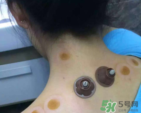 艾灸貼后有水泡怎么辦？貼艾灸貼應(yīng)注意些什么？