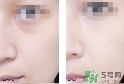 淚溝能自己恢復(fù)嗎？淚溝怎么自己恢復(fù)？