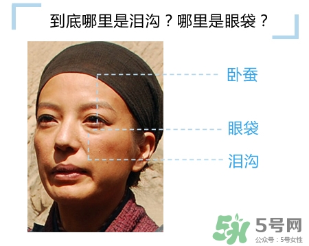 玻尿酸填充淚溝多久恢復(fù)自然？玻尿酸填充淚溝的危害