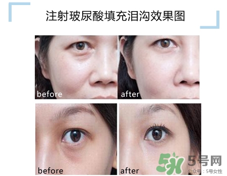 玻尿酸填充淚溝多久恢復(fù)自然？玻尿酸填充淚溝的危害