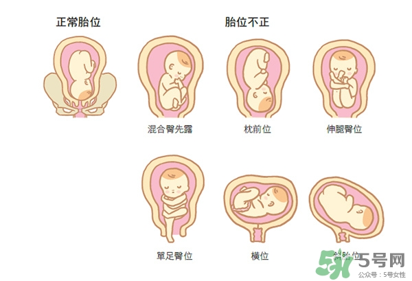 胎位不正如何矯正？胎位不正一定要剖腹產(chǎn)嗎？