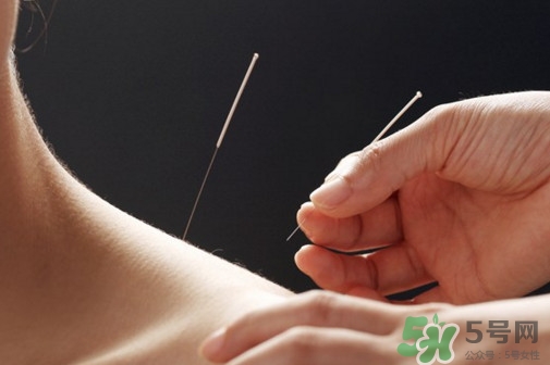 針灸可以天天扎嗎？針灸可以每天扎嗎
