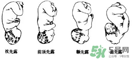 胎位不正能順產(chǎn)嗎？胎位不正怎么辦？