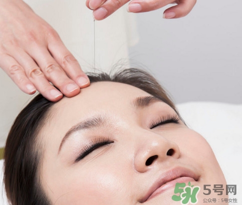 針灸到底疼不疼?。酷樉淖钸m合哪些病