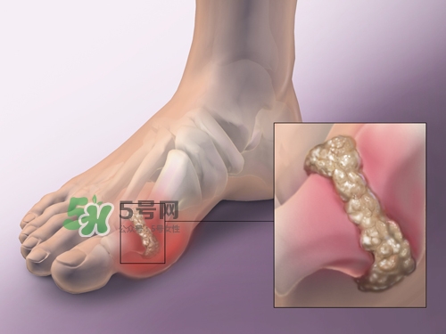 艾艾貼能治痛風(fēng)嗎？艾艾貼治風(fēng)濕嗎？