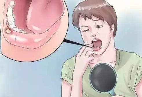 口腔潰瘍牙齦腫痛怎么辦？口腔潰瘍是什么樣子