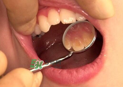 三伏天可以拔牙嗎嗎?三伏天拔牙好嗎？