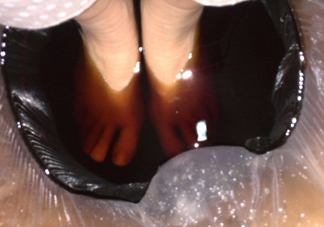 醋泡腳用白醋還是陳醋？泡腳用什么醋最好？