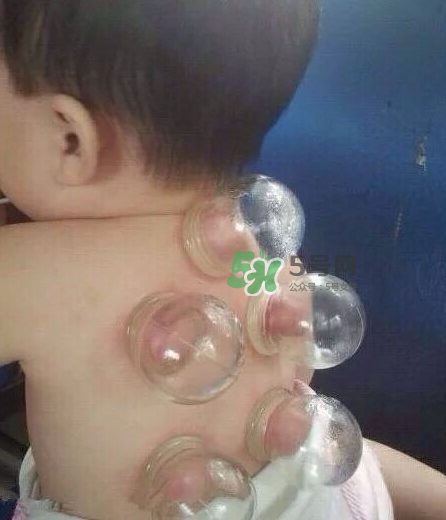 拔火罐后顏色多久消失？拔火罐印子多久能消除？